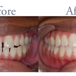 Misaligned teeth before and after alignment
