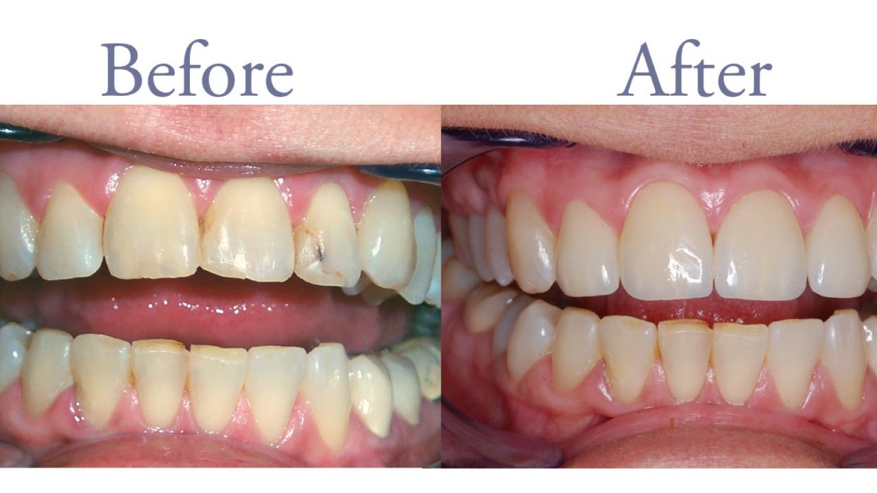 Before and after smile repair