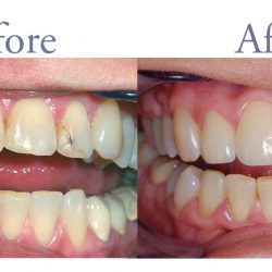 Before and after smile repair