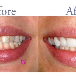 Before and after tooth decay treatment