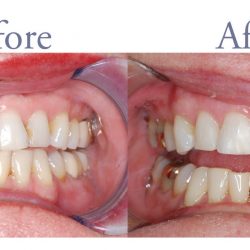 Before and after decay repair and smile alignment