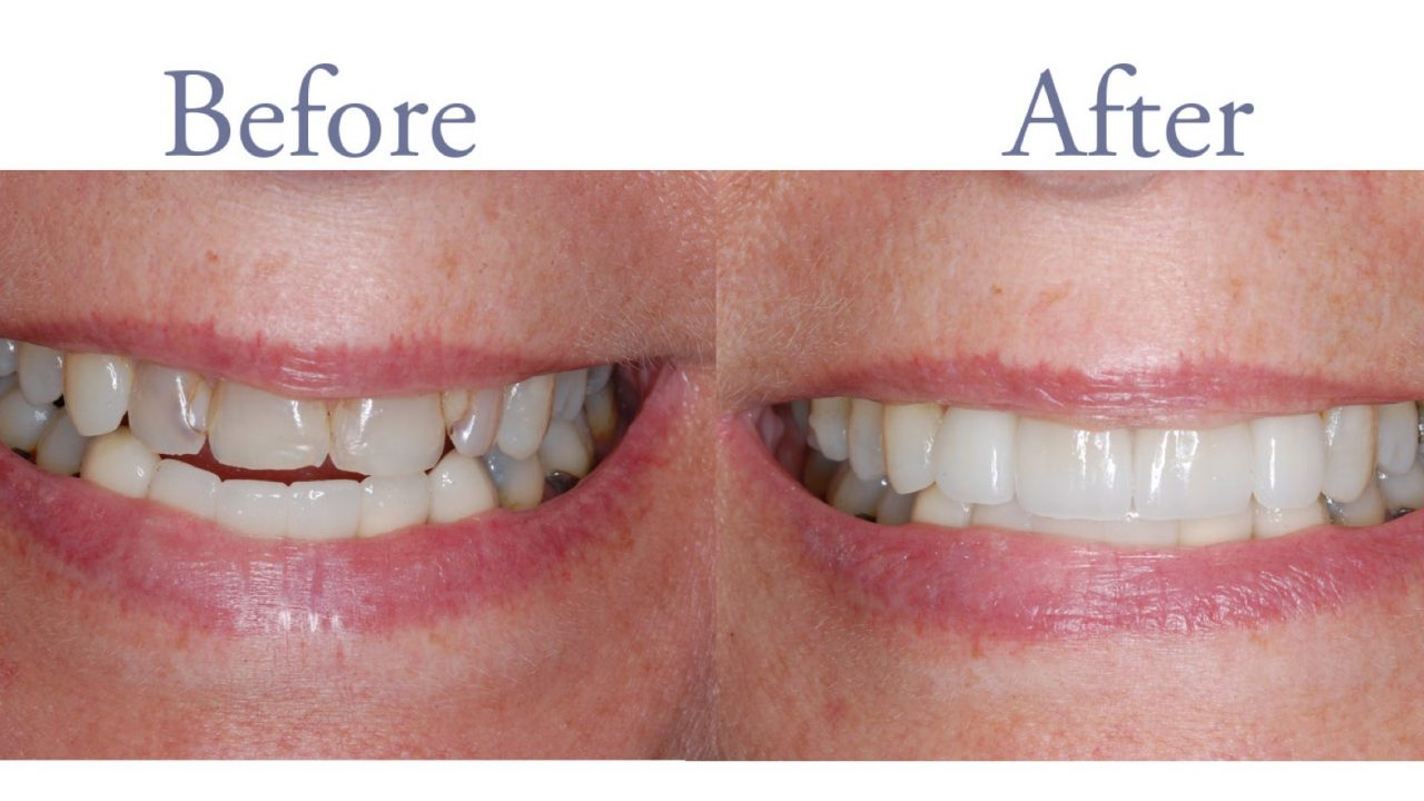 Before and after decay and dental damage