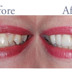 Before and after yellowed teeth