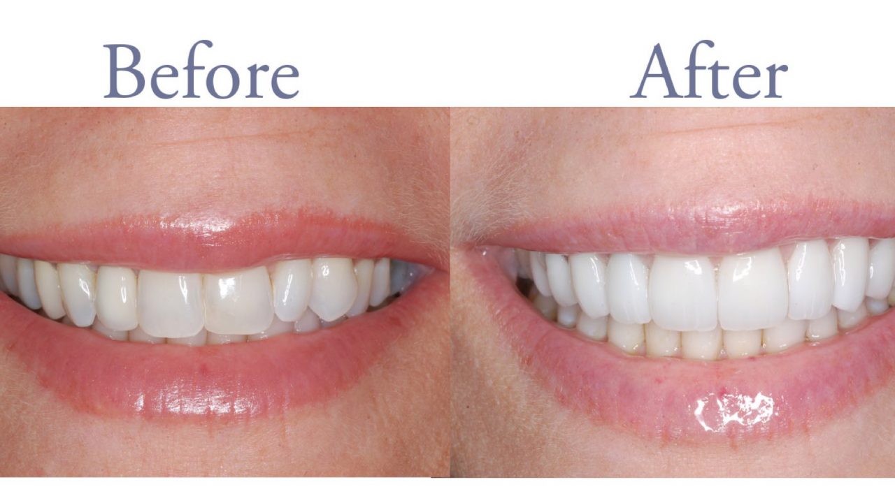 Before and after dental care images